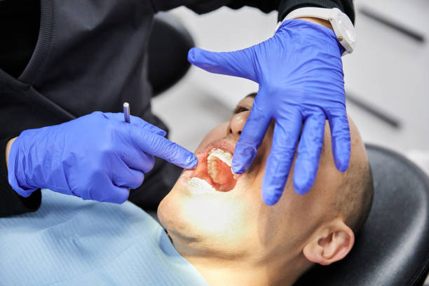 Best Knocked-Out Tooth (Avulsed Tooth) Treatment in La Verne, CA